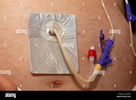 Percutaneous Endoscopic Gastrostomy (PEG)